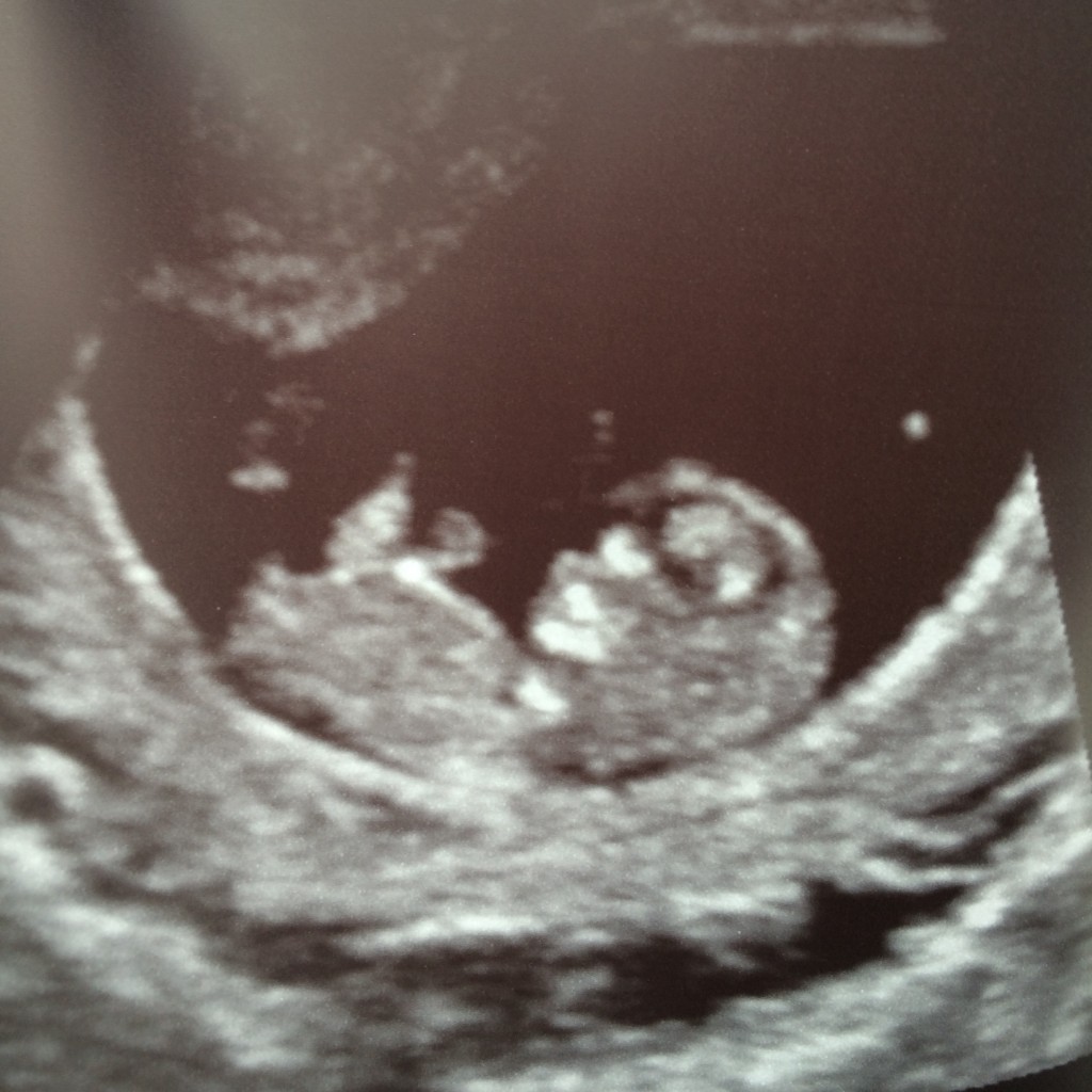 First Trimester Pregnancy FAQs Ultrasound